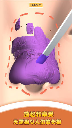 我爱挤黑头截图